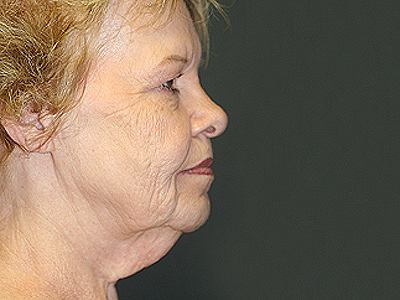Facelift Before & After Image