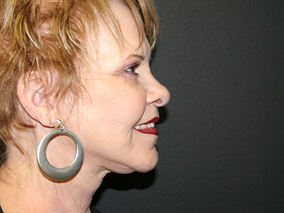 Facelift Before & After Image