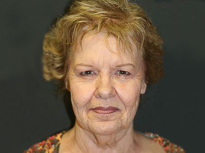 Facelift Before & After Image