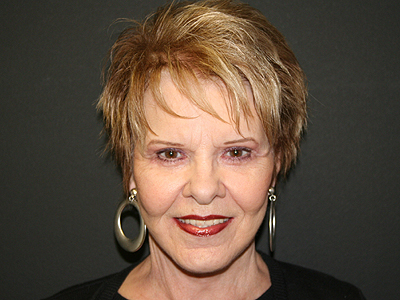 Facelift Before & After Image