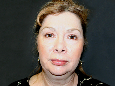 Facelift Before & After Image