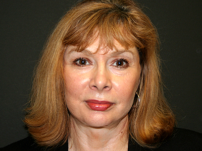 Facelift Before & After Image