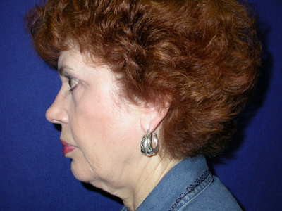 Facelift Before & After Image