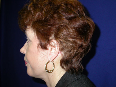 Facelift Before & After Image