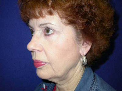 Facelift Before & After Image