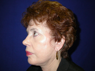 Facelift Before & After Image