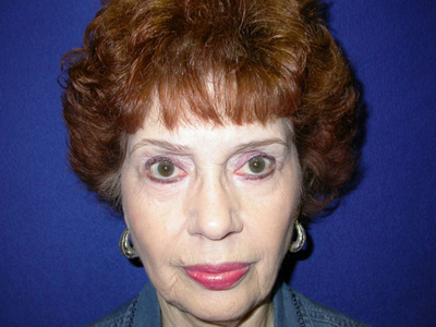 Facelift Before & After Image