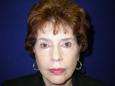Facelift Before & After Image