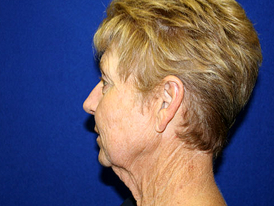 Facelift Before & After Image