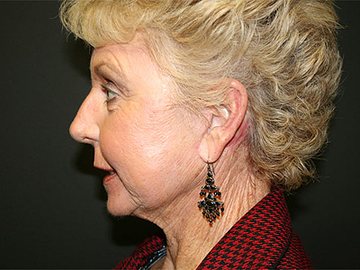 Facelift Before & After Image
