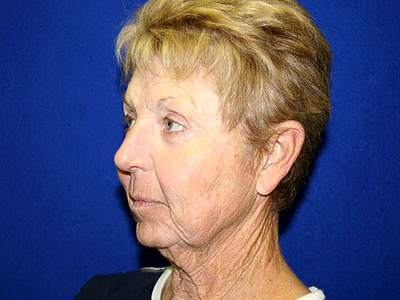 Facelift Before & After Image