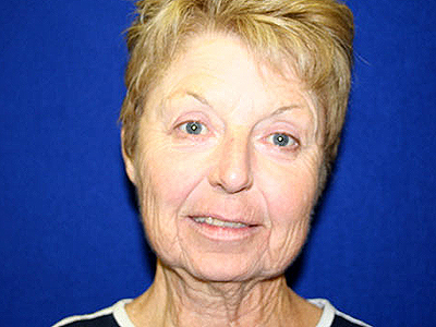 Facelift Before & After Image
