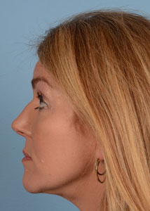 Facelift Before & After Image