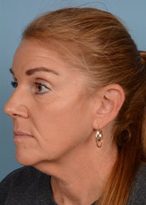 Facelift Before & After Image