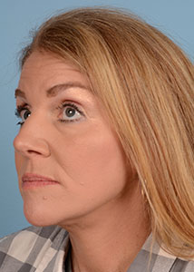 Facelift Before & After Image