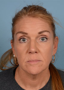 Facelift Before & After Image