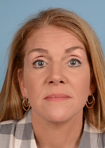 Facelift Before & After Image