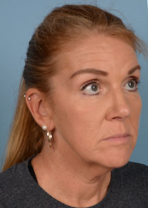 Facelift Before & After Image