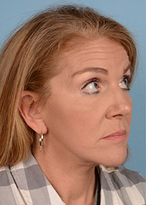 Facelift Before & After Image