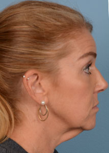Facelift Before & After Image
