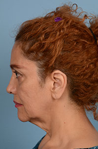 Facelift Before & After Image