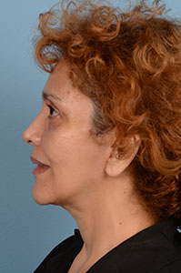 Facelift Before & After Image
