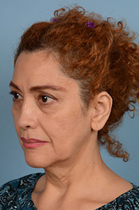 Facelift Before & After Image