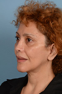 Facelift Before & After Image
