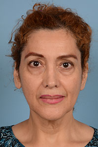 Facelift Before & After Image