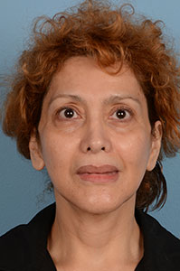 Facelift Before & After Image