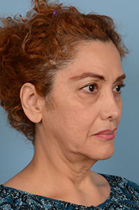 Facelift Before & After Image
