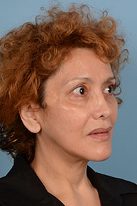 Facelift Before & After Image