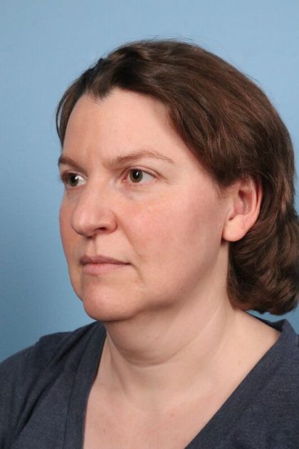 Facelift Before & After Image
