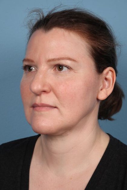 Facelift Before & After Image