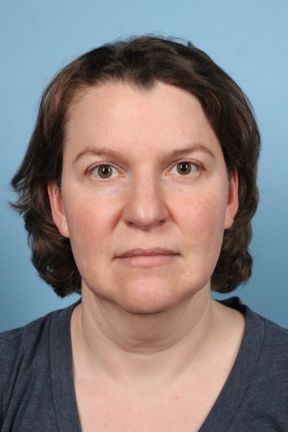Facelift Before & After Image