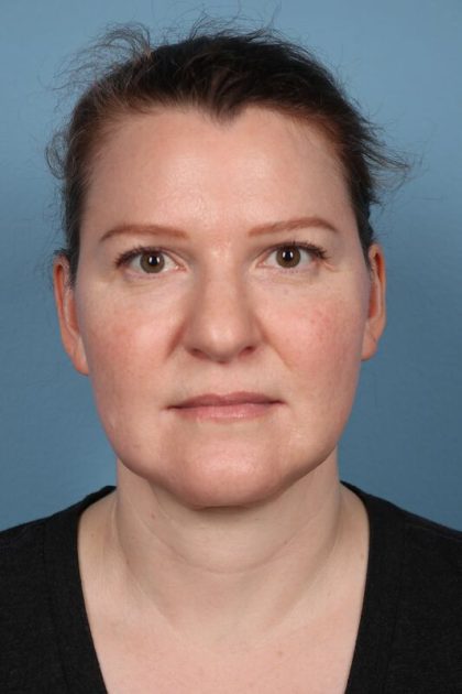 Facelift Before & After Image