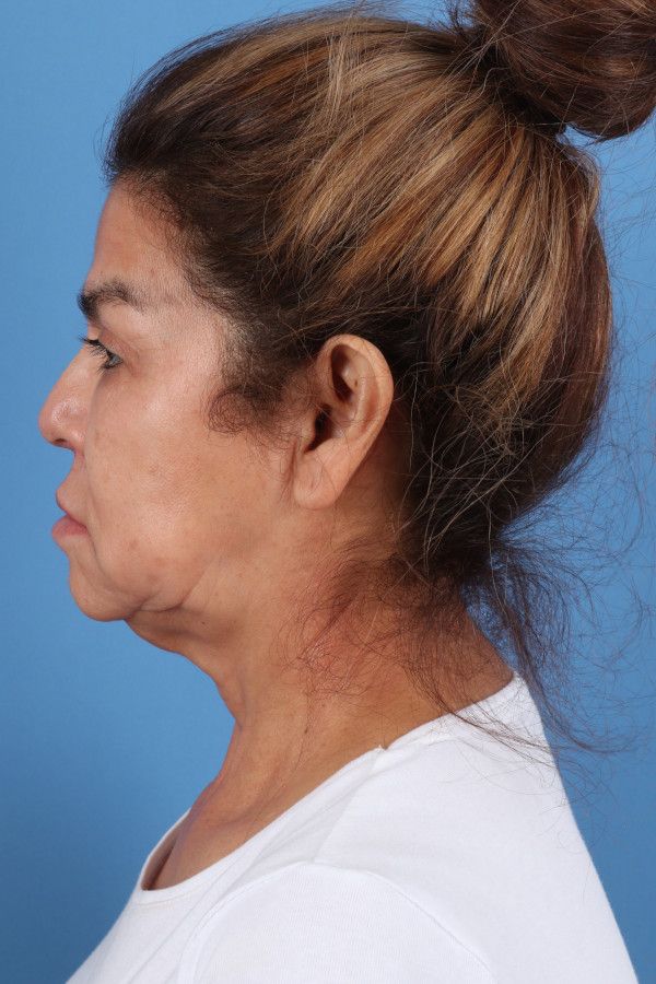 Facelift Before & After Image