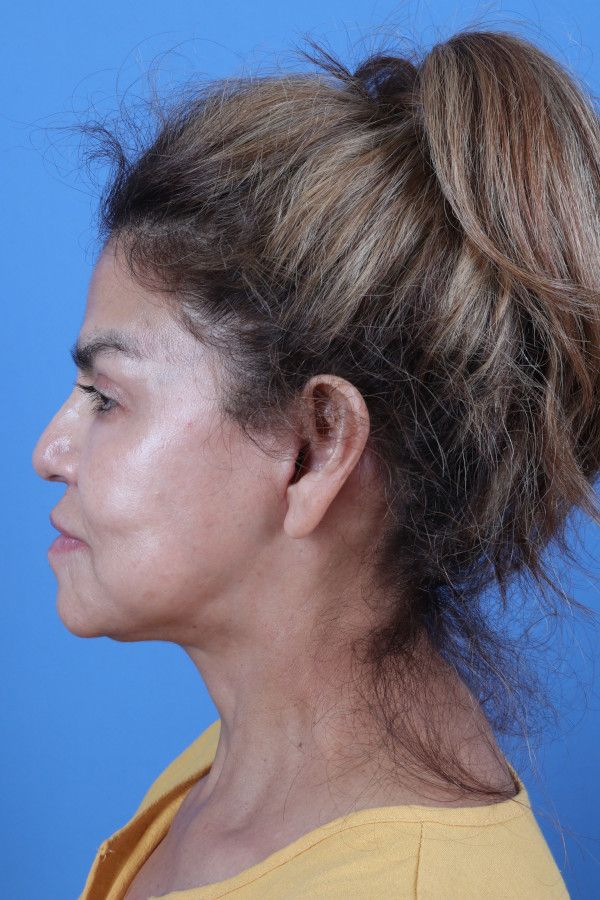 Facelift Before & After Image