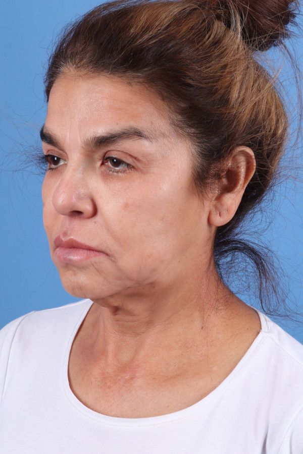 Facelift Before & After Image