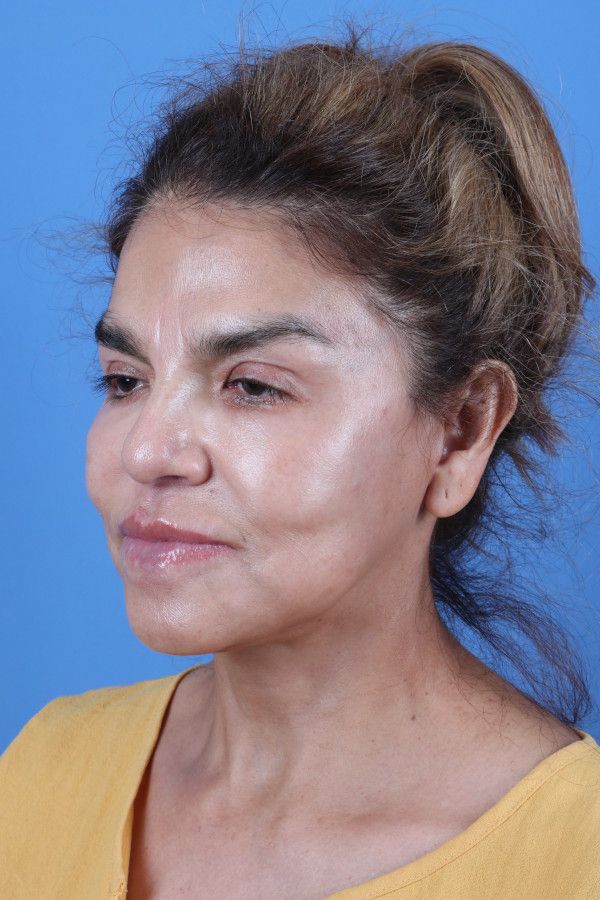 Facelift Before & After Image