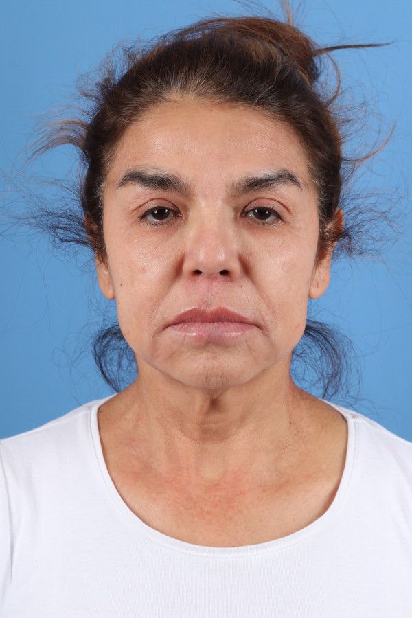 Facelift Before & After Image