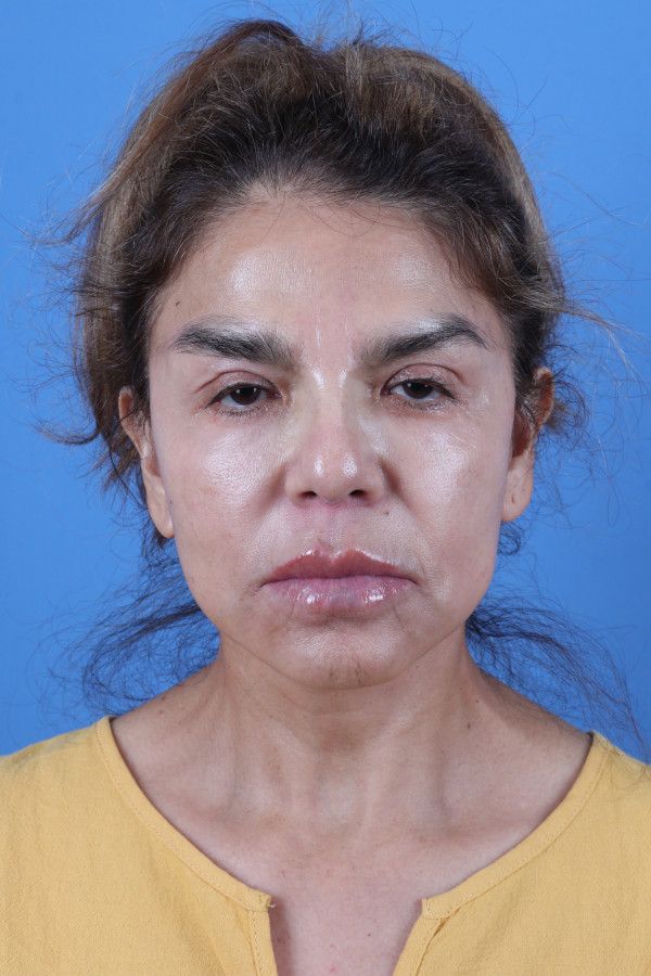 Facelift Before & After Image