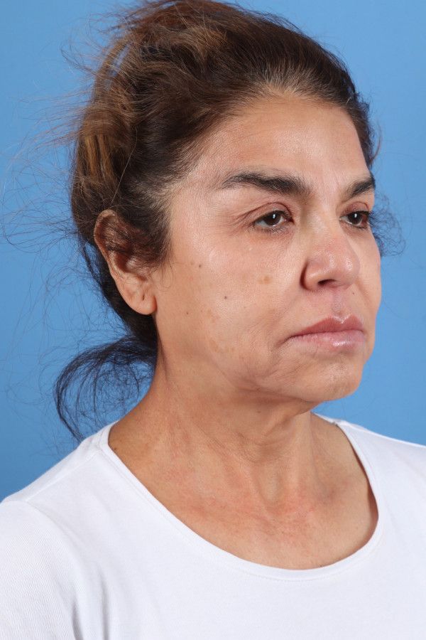 Facelift Before & After Image