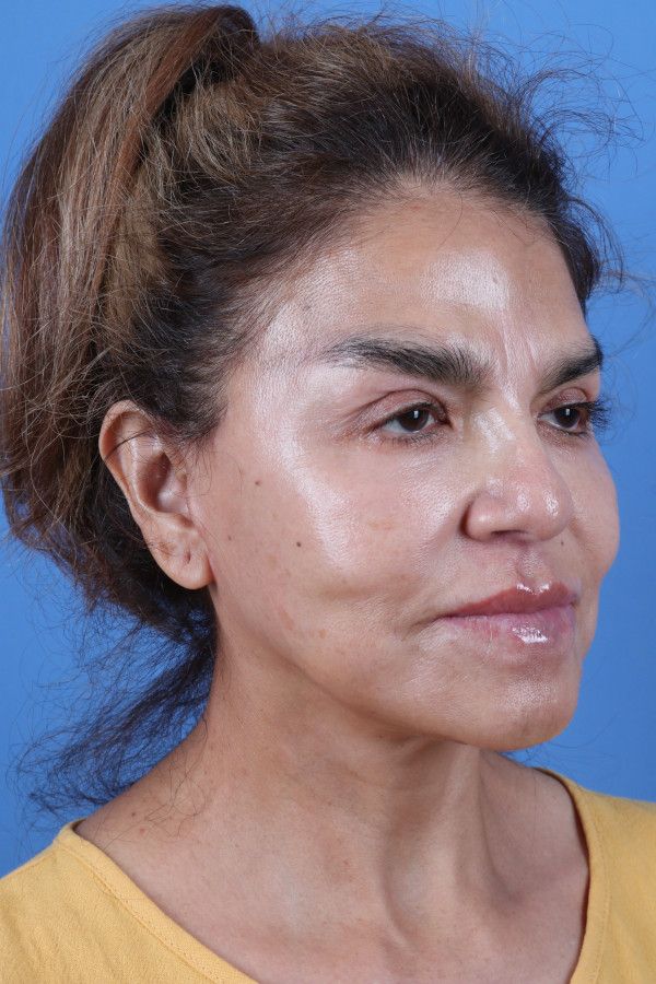 Facelift Before & After Image