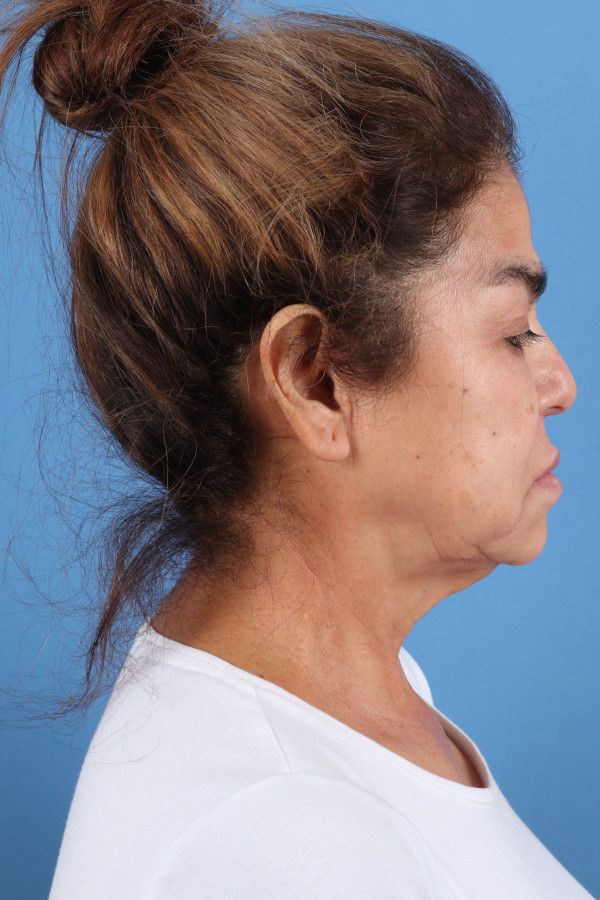 Facelift Before & After Image