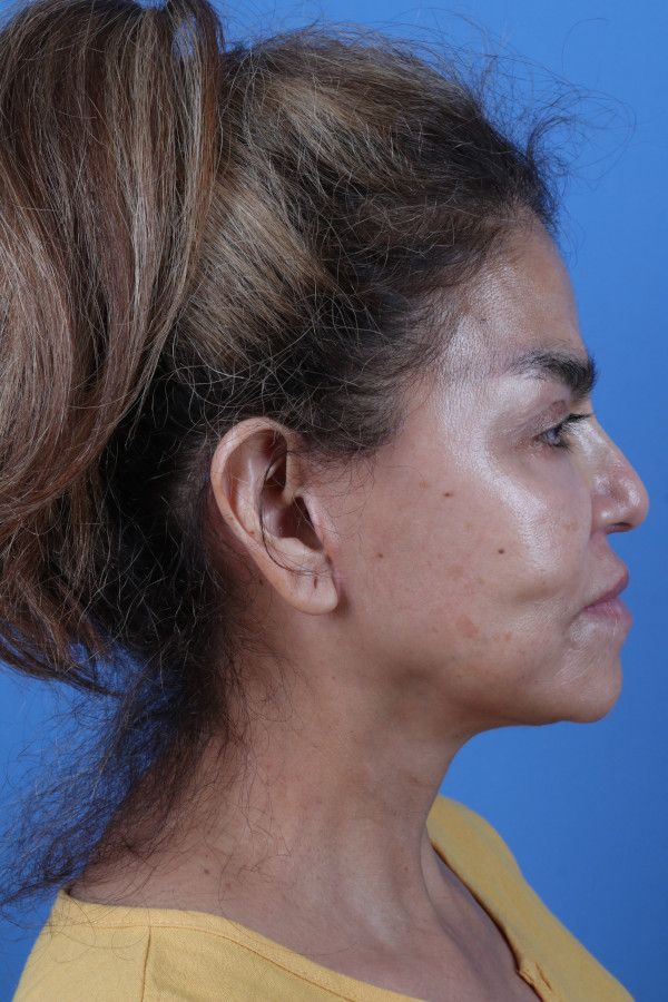 Facelift Before & After Image