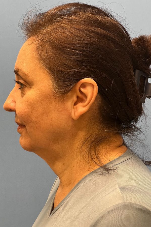 Facelift Before & After Image