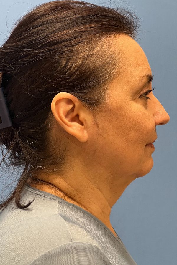 Facelift Before & After Image