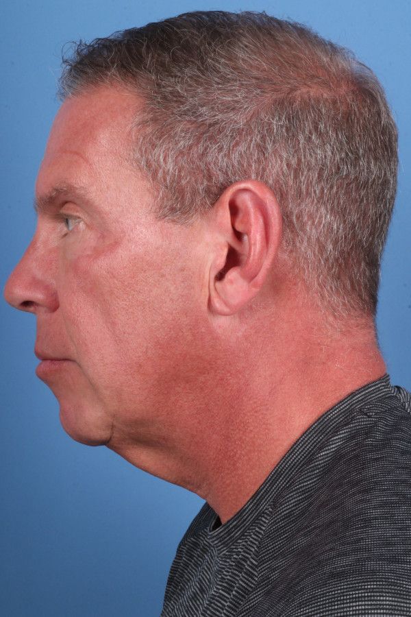 Facelift Before & After Image