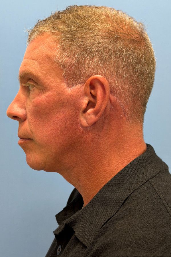 Facelift Before & After Image